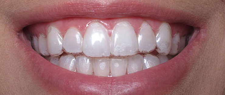 Invisalign dentistes dents lausanne