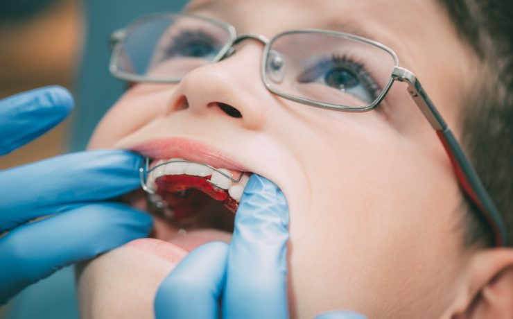 Appareil expansion du palais pour enfant