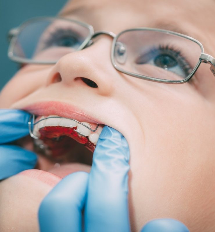 Appareil expansion du palais pour enfant