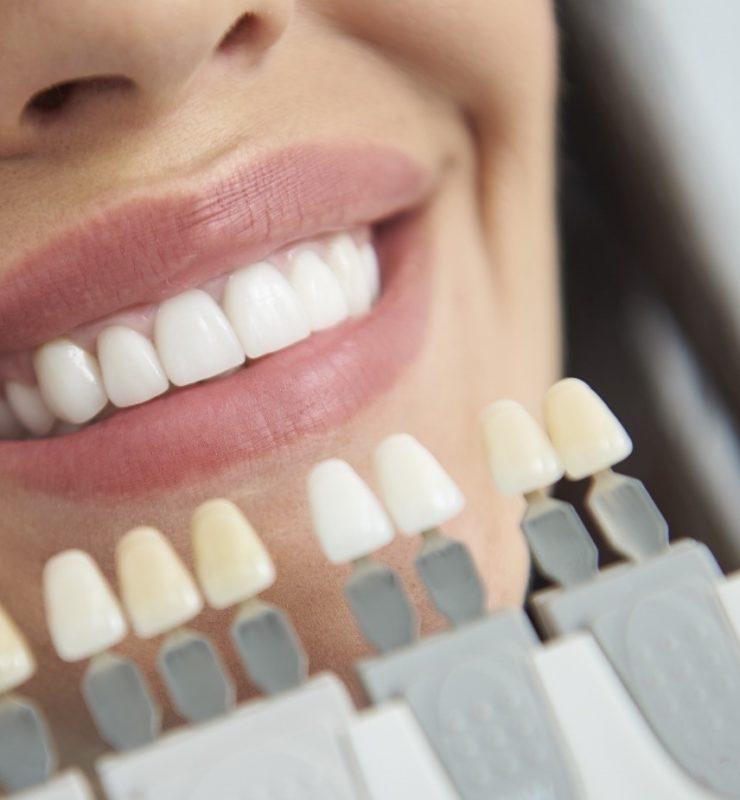 Blanchiment des dents