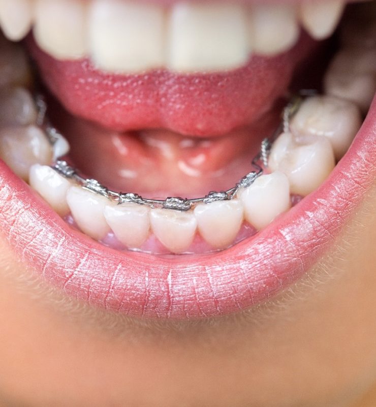 Entretenir ses dents quand on porte un appareil dentaire