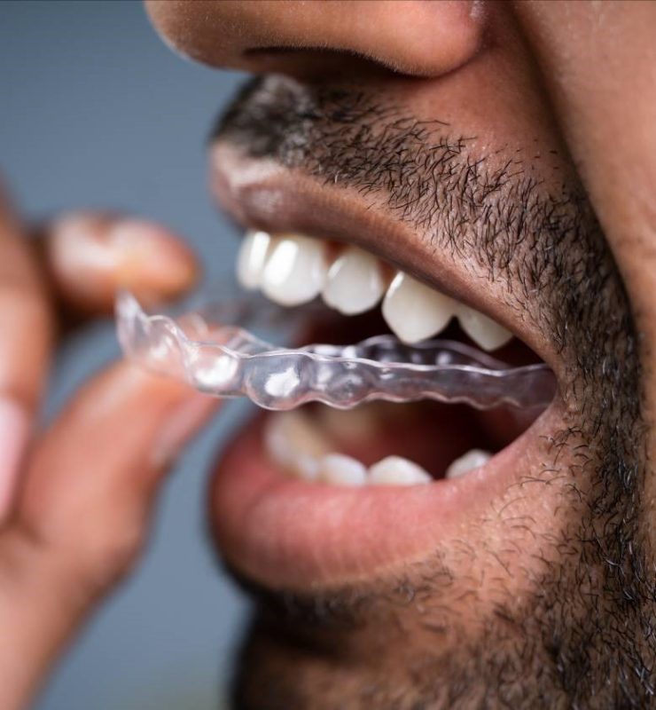 Gouttière d'alignement