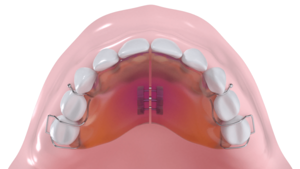 Plaque maxillaire de surélévation