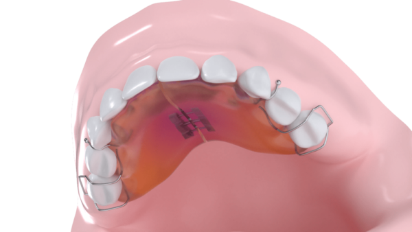 Plaque maxillaire de surélévation