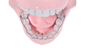 ODF, l'orthopédie dento-faciale
