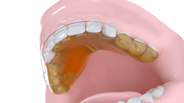 Plaque maxillaire de surélévation