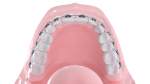 Appareil multibagues vestibulaire maxillaire