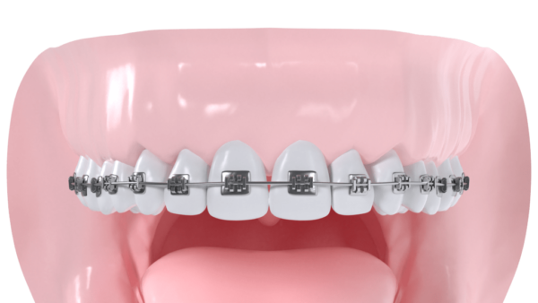 Appareil multibagues vestibulaire maxillaire