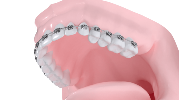 Appareil multibagues vestibulaire maxillaire