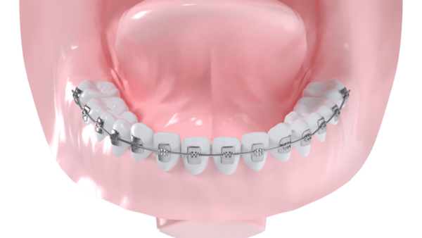 Appareil multibagues vestibulaire mandibulaire