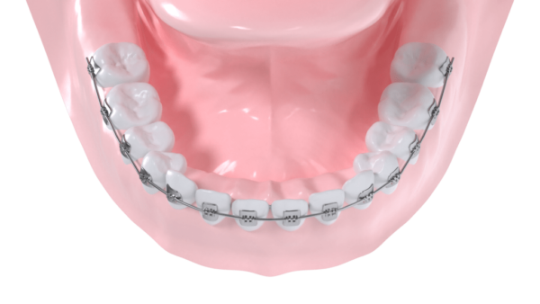 Appareil multibagues vestibulaire mandibulaire