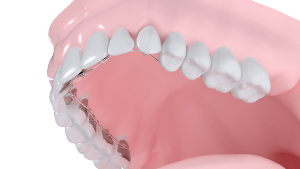 Appareil multibagues lingual maxillaire