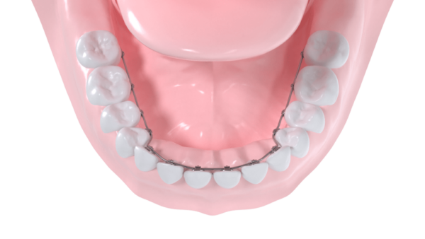 Appareil multibagues lingual mandibulaire