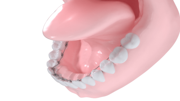 Appareil multibagues lingual mandibulaire