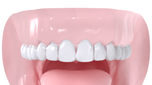 gouttiere orthodontie suisse