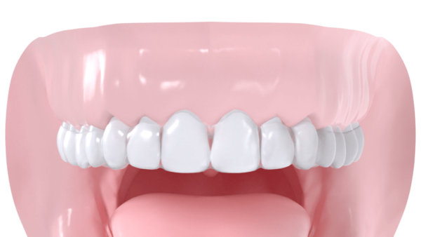 gouttiere orthodontie suisse