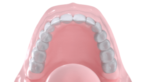 Gouttière mandibulaire