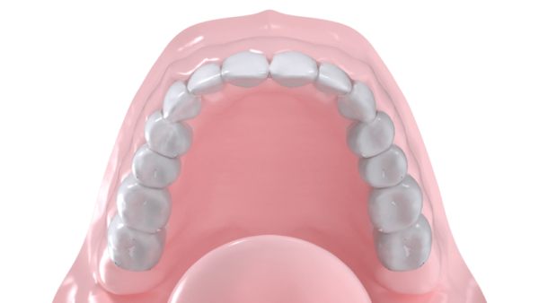 Gouttière mandibulaire