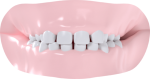 Occlusion croisée bilatérale