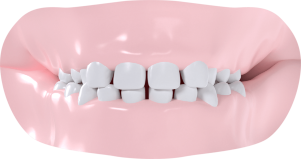 Occlusion croisée bilatérale