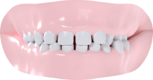 Occlusion croisée gauche