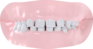 Occlusion croisée droite