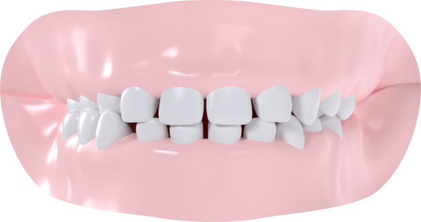 Occlusion croisée droite