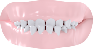 Occlusion croisée antérieure