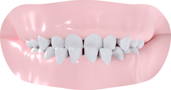 Occlusion croisée antérieure