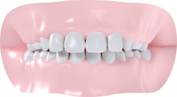 Classe II Dentaire et/ou squelettique