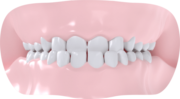 Classe III Dentaire et/ou squelettique