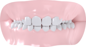 Occlusion croisée bilatérale