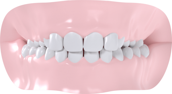 Occlusion croisée bilatérale