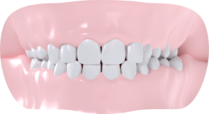 Occlusion croisée gauche