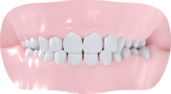 Occlusion croisée gauche