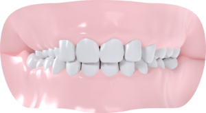 Occlusion croisée droite