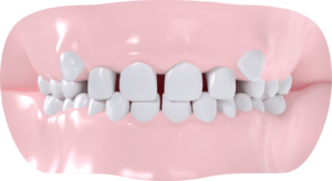 Diastèmes maxillaires