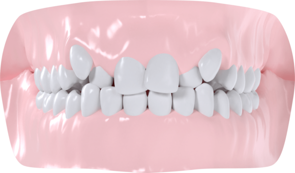 Encombrement maxillaire