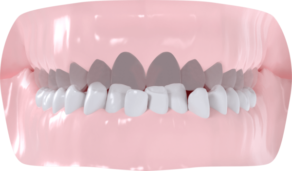 Encombrement mandibulaire