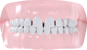 Diastèmes maxillaires