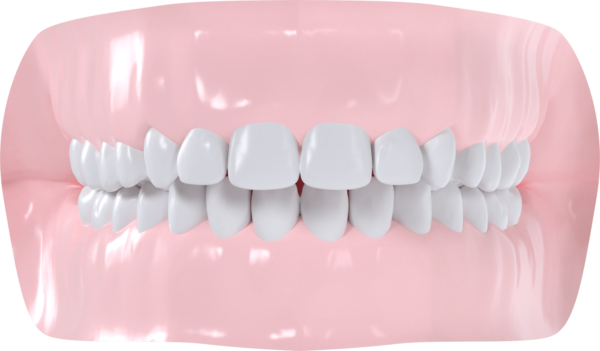 Classe II Dentaire et/ou squelettique