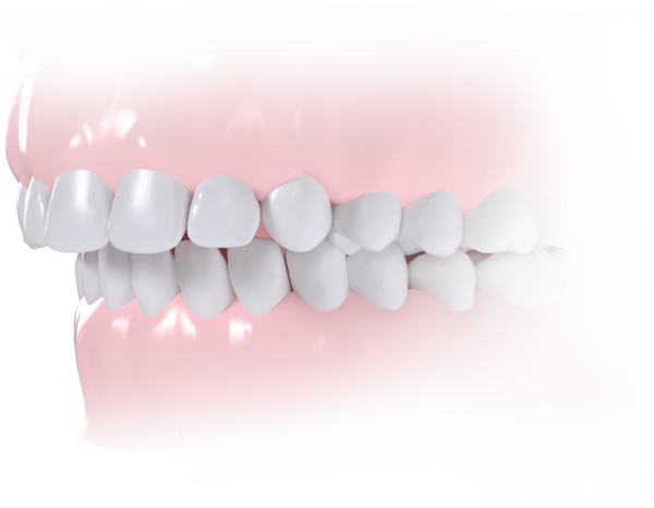 Classe II Dentaire et/ou squelettique