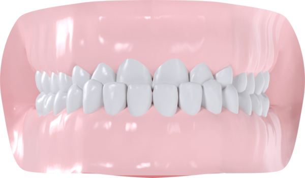 Classe III Dentaire et/ou squelettique