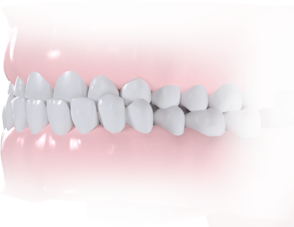 Classe III Dentaire et/ou squelettique