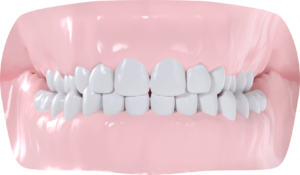 Occlusion croisée bilatérale