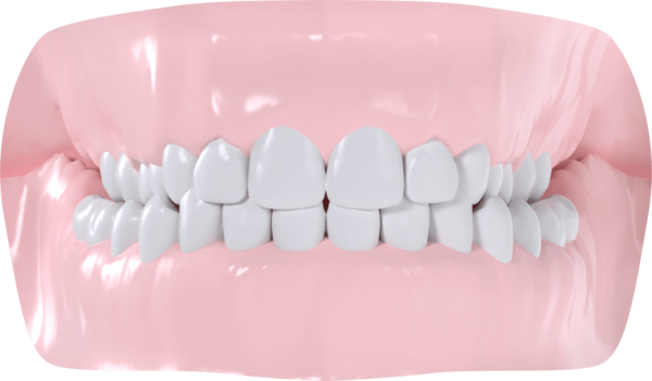 Occlusion croisée bilatérale