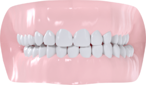 Occlusion croisée gauche