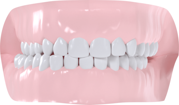 Occlusion croisée droite