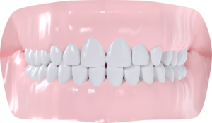 Occlusion normale