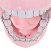 ODF, l'orthopédie dento-faciale